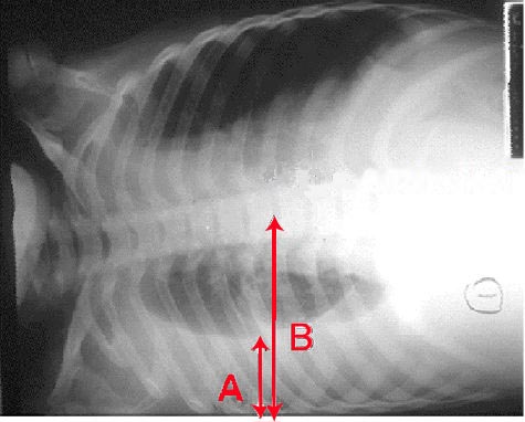 RX en decúbito lateral con flechas que señalan líquido pleural