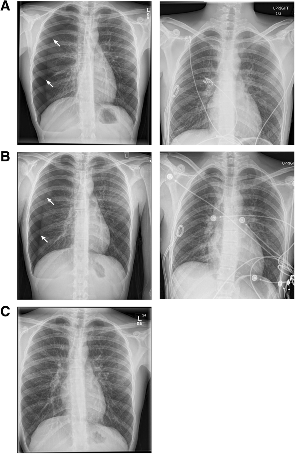 Composición de radiografías anotadas de neumotórax derecho y su evolución