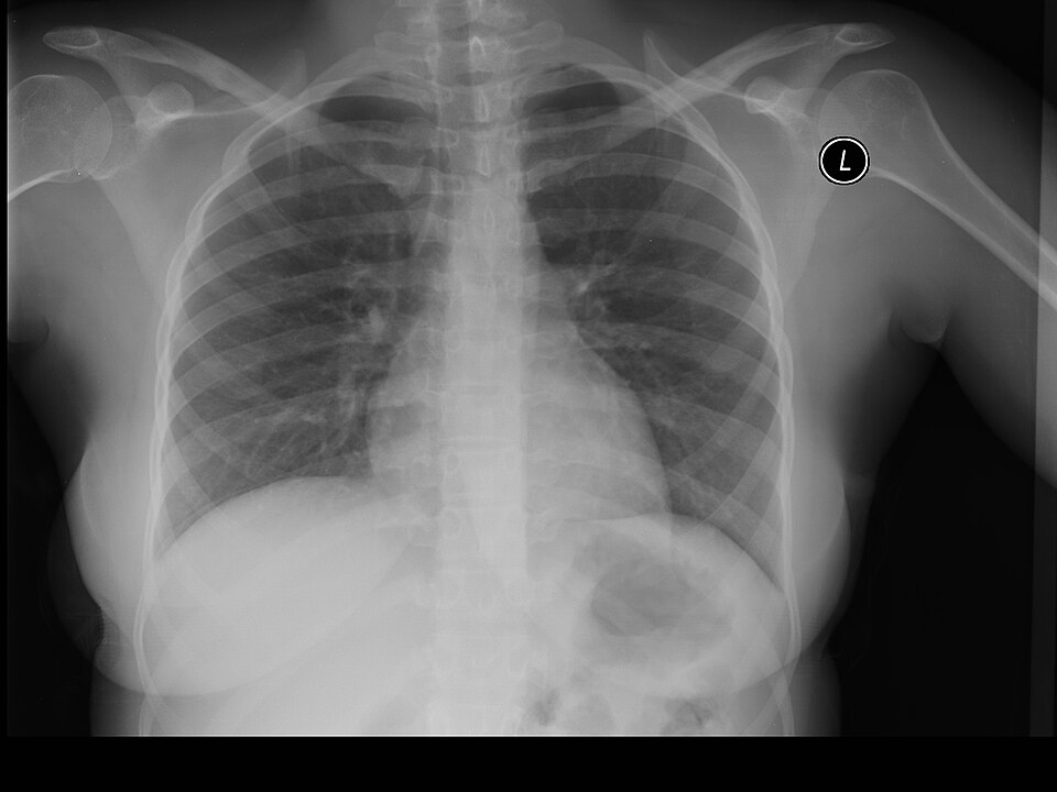 Radiografía posteroanterior de tórax utilizada como referencia normal